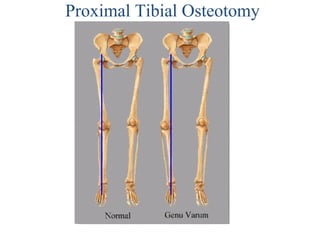 Proximal Tibial Osteotomy
 