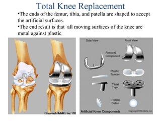 •The ends of the femur, tibia, and patella are shaped to accept
the artificial surfaces.
•The end result is that all moving surfaces of the knee are
metal against plastic
Total Knee Replacement
 