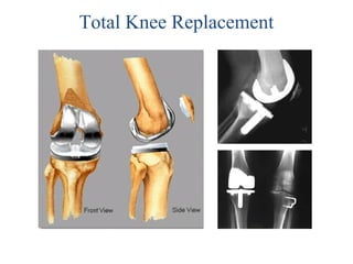 Total Knee Replacement
 