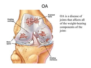 OA
OA is a disease of
joints that affects all
of the weight-bearing
components of the
joint:
 