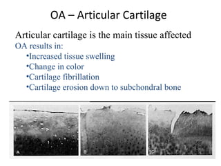 OA – Articular Cartilage
Articular cartilage is the main tissue affected
OA results in:
•Increased tissue swelling
•Change in color
•Cartilage fibrillation
•Cartilage erosion down to subchondral bone
 