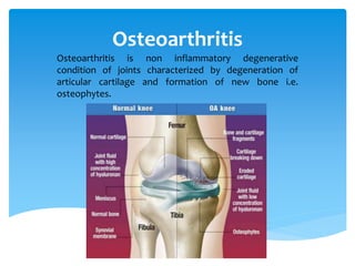 Osteoarthritis | PPTX