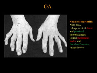 OA
Nodal osteoarthritis
Note bony
enlargement of distal
and proximal
interphalangeal
joints (Heberden's
nodes and
Bouchard's nodes,
respectively).
 