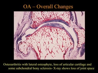 Osteoarthritis with lateral osteophyte, loss of articular cartilage and
some subchondral bony sclerosis- X-ray shows loss of joint space
OA – Overall Changes
 