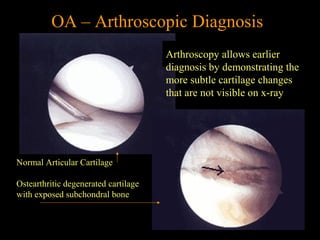 OA – Arthroscopic Diagnosis
Normal Articular Cartilage
Ostearthritic degenerated cartilage
with exposed subchondral bone
Arthroscopy allows earlier
diagnosis by demonstrating the
more subtle cartilage changes
that are not visible on x-ray
 