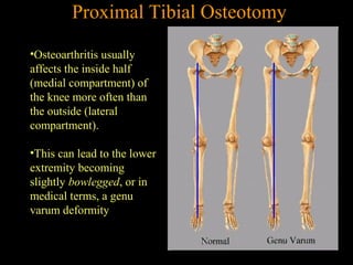 •Osteoarthritis usually
affects the inside half
(medial compartment) of
the knee more often than
the outside (lateral
compartment).
•This can lead to the lower
extremity becoming
slightly bowlegged, or in
medical terms, a genu
varum deformity
Proximal Tibial Osteotomy
 