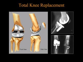 Total Knee Replacement
 