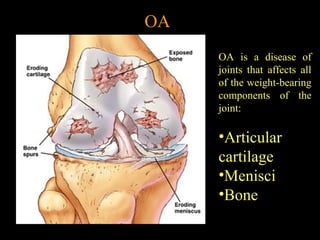 OA
OA is a disease of
joints that affects all
of the weight-bearing
components of the
joint:
•Articular
cartilage
•Menisci
•Bone
 