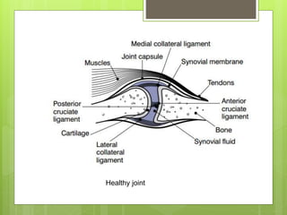 Healthy joint
 