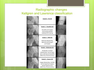 Radiographic changes
Kellgren and Lawrence classification
 