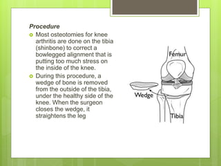 Procedure
 Most osteotomies for knee
arthritis are done on the tibia
(shinbone) to correct a
bowlegged alignment that is
putting too much stress on
the inside of the knee.
 During this procedure, a
wedge of bone is removed
from the outside of the tibia,
under the healthy side of the
knee. When the surgeon
closes the wedge, it
straightens the leg
 