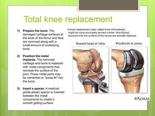 Total knee replacement
1) Prepare the bone. The
damaged cartilage surfaces at
the ends of the femur and tibia
are removed along with a
small amount of underlying
bone.
2) Position the metal
implants. The removed
cartilage and bone is replaced
with metal components that
recreate the surface of the
joint. These metal parts may
be cemented or "press-fit" into
the bone.
3) Insert a spacer. A medical-
grade plastic spacer is inserted
between the metal
components to create a
smooth gliding surface.
A knee replacement (also called knee arthroplasty)
might be more accurately termed a knee "resurfacing“
because only the surface of the bones are actually replaced
 
