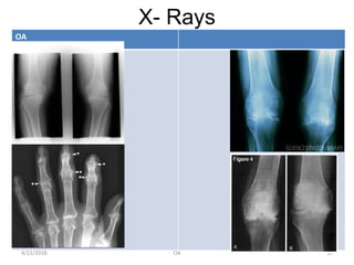 X- Rays
OA
4/12/2018 OA 10
 