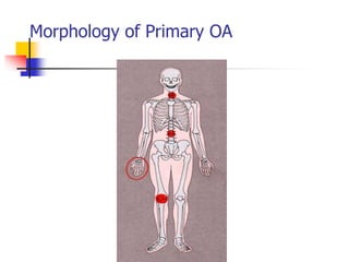 Morphology of Primary OA
 