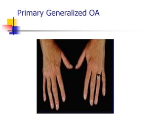 Primary Generalized OA
 