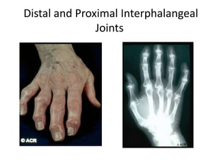 Distal and Proximal Interphalangeal
Joints
 