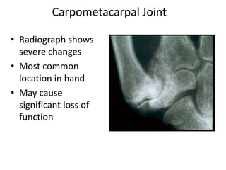 • Radiograph shows
severe changes
• Most common
location in hand
• May cause
significant loss of
function
Carpometacarpal Joint
 