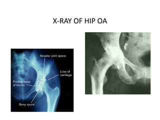 X-RAY OF HIP OA
 