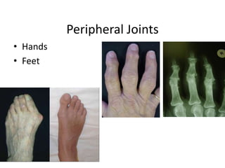 Peripheral Joints
• Hands
• Feet
 