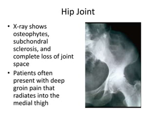 • X-ray shows
osteophytes,
subchondral
sclerosis, and
complete loss of joint
space
• Patients often
present with deep
groin pain that
radiates into the
medial thigh
Hip Joint
 