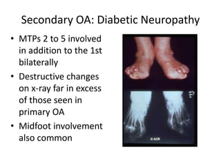 Secondary OA: Diabetic Neuropathy
• MTPs 2 to 5 involved
in addition to the 1st
bilaterally
• Destructive changes
on x-ray far in excess
of those seen in
primary OA
• Midfoot involvement
also common
 