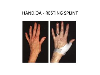 HAND OA - RESTING SPLINT
 