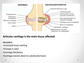 Osteoarthritis | PPTX