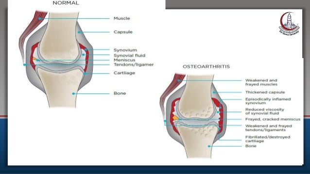Osteoarthritis In elderly | PPTX | Bone and Joint Conditions | Diseases ...