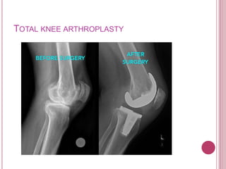 TOTAL KNEE ARTHROPLASTY
 