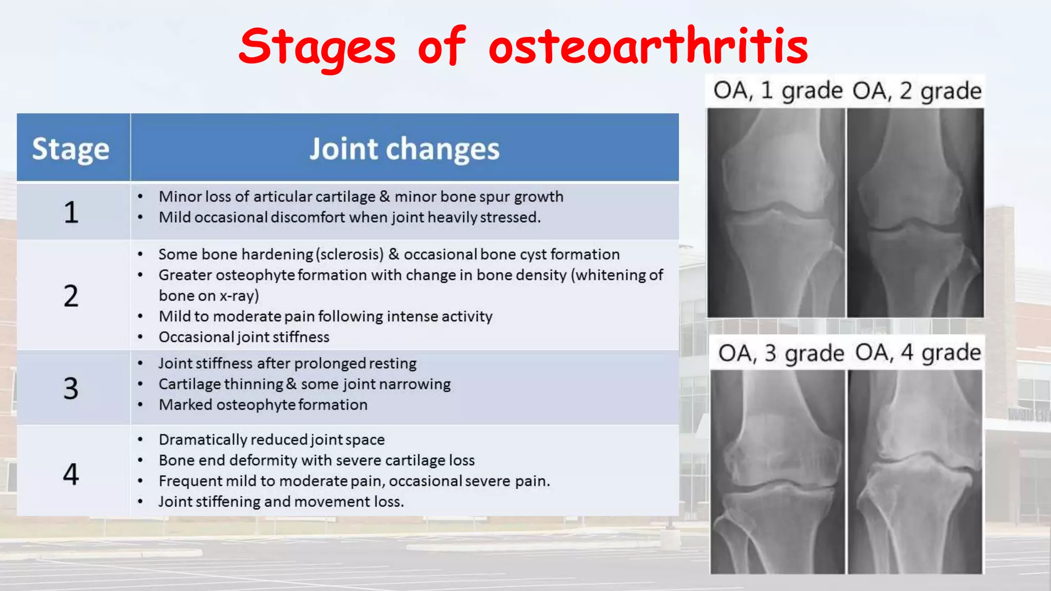 Osteoarthritis of joints and related treatment | PPTX