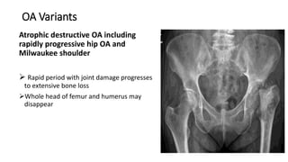 OA Variants
Atrophic destructive OA including
rapidly progressive hip OA and
Milwaukee shoulder
 Rapid period with joint damage progresses
to extensive bone loss
Whole head of femur and humerus may
disappear
 