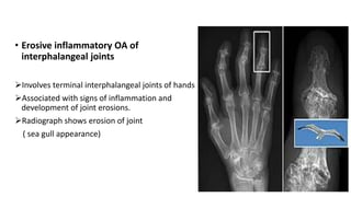 • Erosive inflammatory OA of
interphalangeal joints
Involves terminal interphalangeal joints of hands
Associated with signs of inflammation and
development of joint erosions.
Radiograph shows erosion of joint
( sea gull appearance)
 