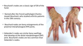 • Bouchard's nodes are a classic sign of OA of the
hand.
• Named after the French pathologist Charles-
Joseph Bouchard, who studied arthritis patients
in the 19th century.
• Bouchard nodes are bony enlargements of the
proximal interphalangeal (PIP) joints.
• Heberden’s nodes are similar bony swellings
that develop at the distal interphalangeal (DIP)
joint. Bouchard's nodes are less common than
Heberden's nodes.
 