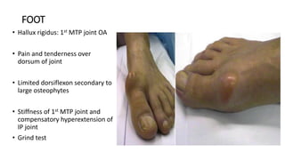 FOOT
• Hallux rigidus: 1st MTP joint OA
• Pain and tenderness over
dorsum of joint
• Limited dorsiflexon secondary to
large osteophytes
• Stiffness of 1st MTP joint and
compensatory hyperextension of
IP joint
• Grind test
 