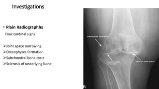 Investigations
• Plain Radiographhs
Four cardinal signs
Joint space narrowing
Osteophytes formation
Subchondral bone cysts
Sclerosis of underlying bone
 