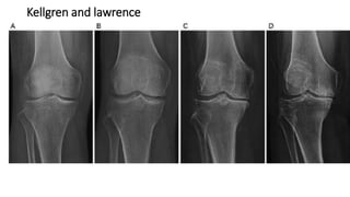 Kellgren and lawrence
 