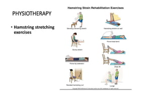 PHYSIOTHERAPY
• Hamstring stretching
exercises
 