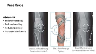 Knee Brace
Advantages
• Enhanced stability
• Reduced swelling
• Reduced pressure
• Increased confidence
 
