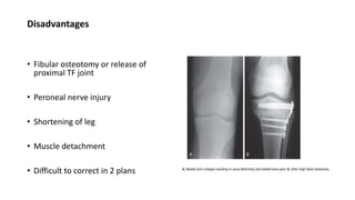 Disadvantages
• Fibular osteotomy or release of
proximal TF joint
• Peroneal nerve injury
• Shortening of leg
• Muscle detachment
• Difficult to correct in 2 plans
 