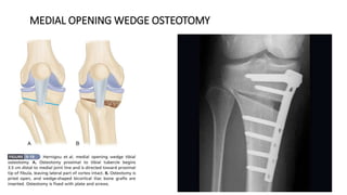 MEDIAL OPENING WEDGE OSTEOTOMY
 