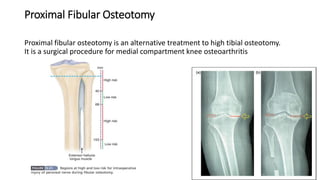 Proximal Fibular Osteotomy
Proximal fibular osteotomy is an alternative treatment to high tibial osteotomy.
It is a surgical procedure for medial compartment knee osteoarthritis
 