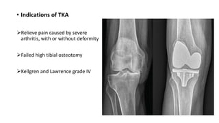 • Indications of TKA
Relieve pain caused by severe
arthritis, with or without deformity
Failed high tibial osteotomy
Kellgren and Lawrence grade IV
 