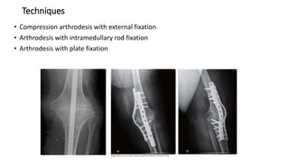 Techniques
• Compression arthrodesis with external fixation
• Arthrodesis with intramedullary rod fixation
• Arthrodesis with plate fixation
 