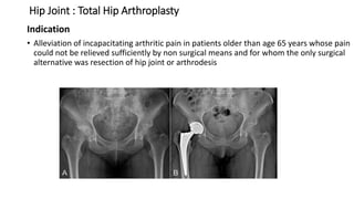 Hip Joint : Total Hip Arthroplasty
Indication
• Alleviation of incapacitating arthritic pain in patients older than age 65 years whose pain
could not be relieved sufficiently by non surgical means and for whom the only surgical
alternative was resection of hip joint or arthrodesis
 