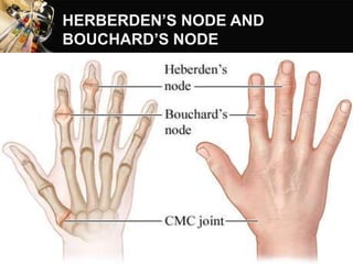 HERBERDEN’S NODE AND
BOUCHARD’S NODE
 