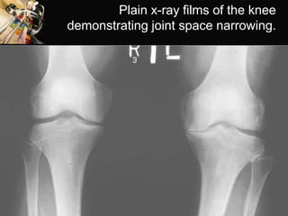Plain x-ray films of the knee
demonstrating joint space narrowing.
 