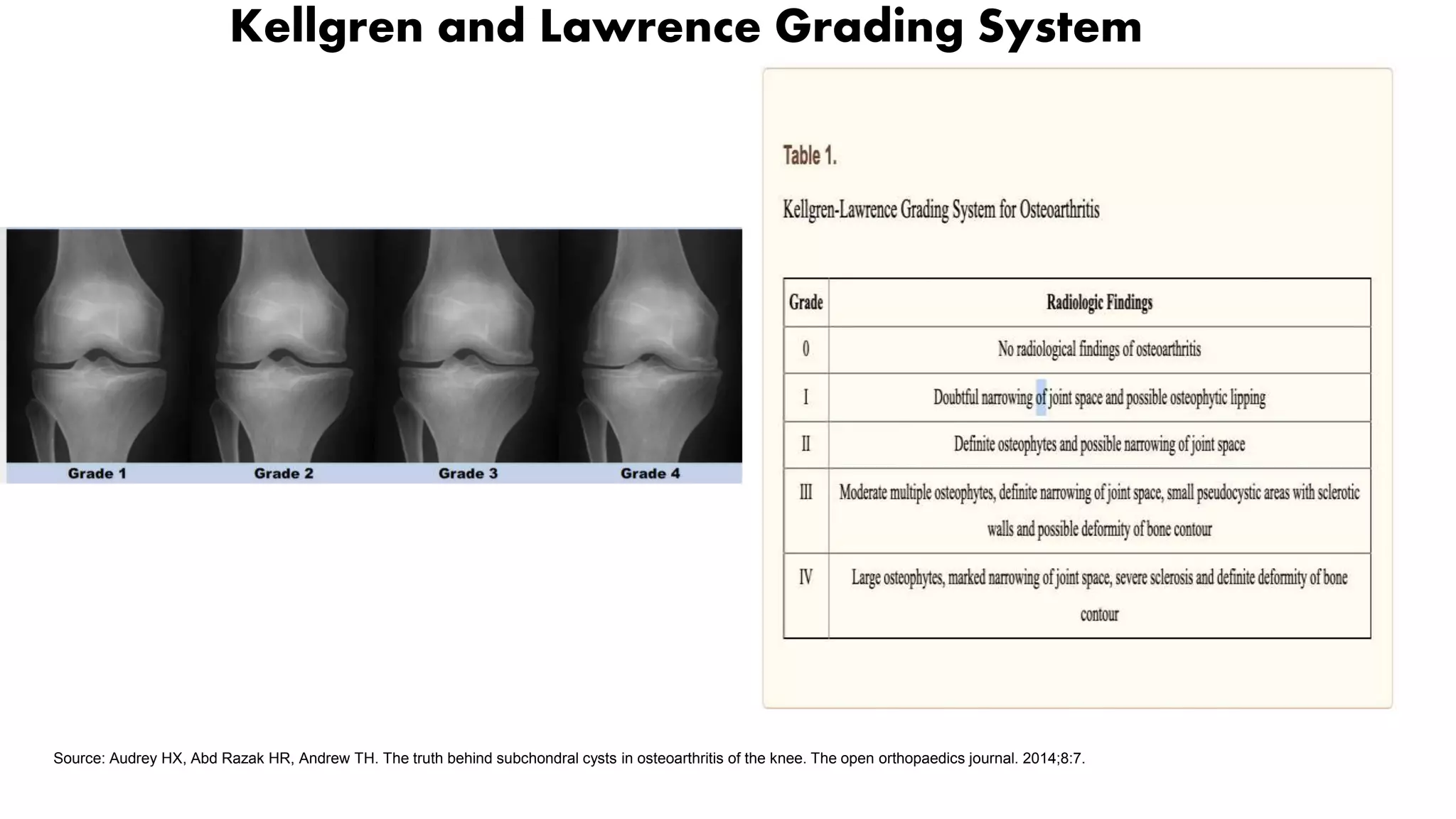 osteoarthritis.pptx
