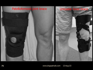 13-Aug-23
www.drgspatnaik.com
71
Patellofemoral joint brace Unloader knee brace
 