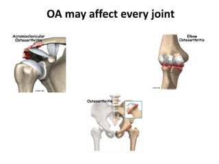 Osteoarthritis with mechanism, pathology and treatment | PPT