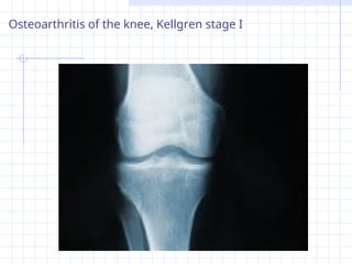OSTEOARTHRITIS in depth review in orthopaedic .ppt
